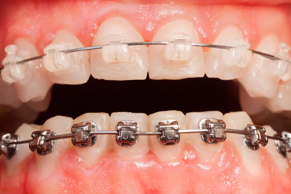Fixed Braces